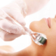 What is Microneedling; and why are people making a fuss about it?